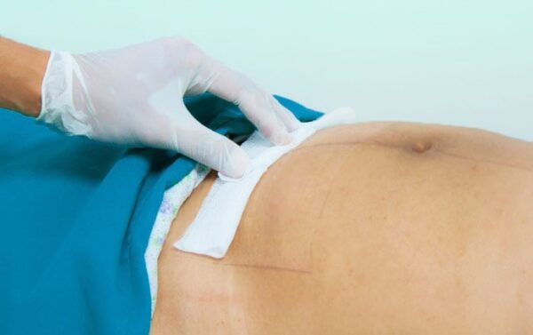 HERIDAS OPERATORIAS